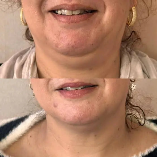 Révélez la forme en V de votre visage